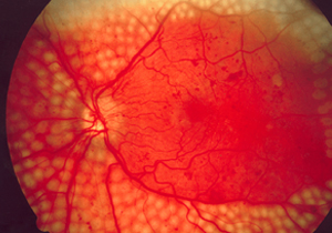 Fundus_photo_showing_scatter_laser_surgery_for_diabetic_retinopathy